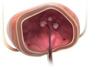 Entfernung_nicht-muskelinvasiver_Blasentumoren_mit_det_TULA_-Lasertherapie_der_biolitec_____biolitec__