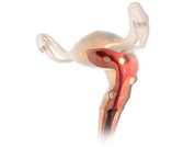 uterus-befund-myom-polyp-160916