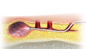 steissbeinfistel-behandlung-illu02-150915LQ